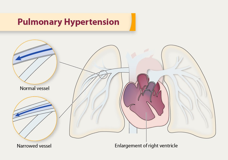 Is Pulmonary Hypertension a Disability? 